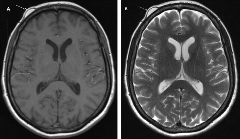 Subgaleal Lipoma: Imaging Findings.