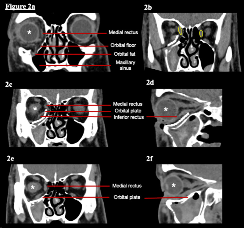 A Rare Case of Cyclotorsion Due to Medial Rectus Displacement Following Orbital Trauma.
