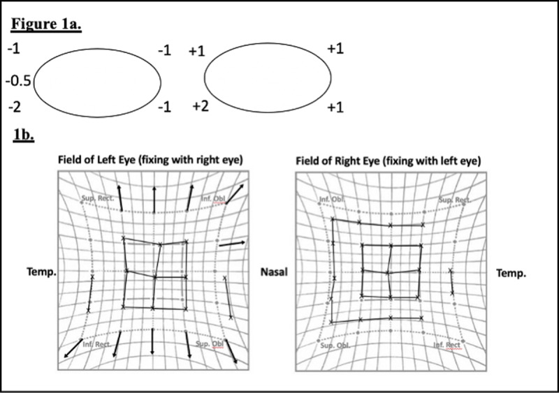 A Rare Case of Cyclotorsion Due to Medial Rectus Displacement Following Orbital Trauma.