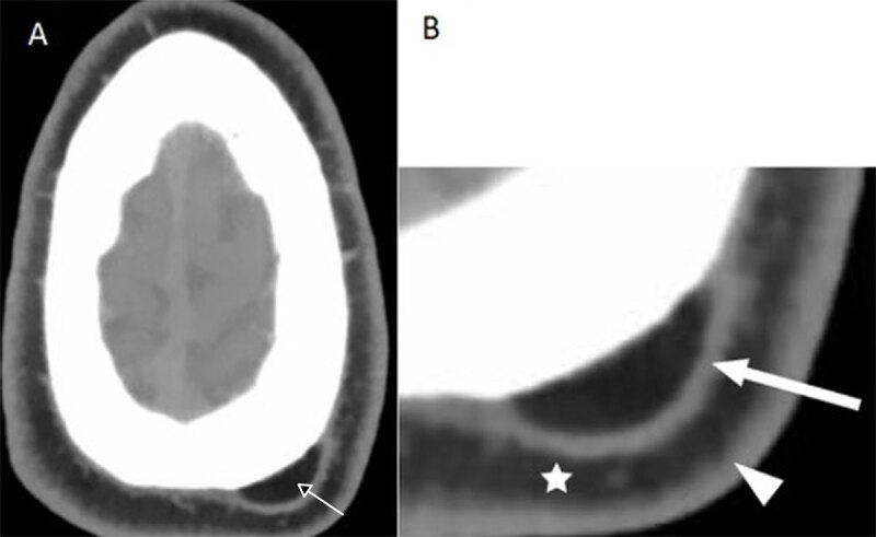 Subgaleal Lipoma: Imaging Findings.