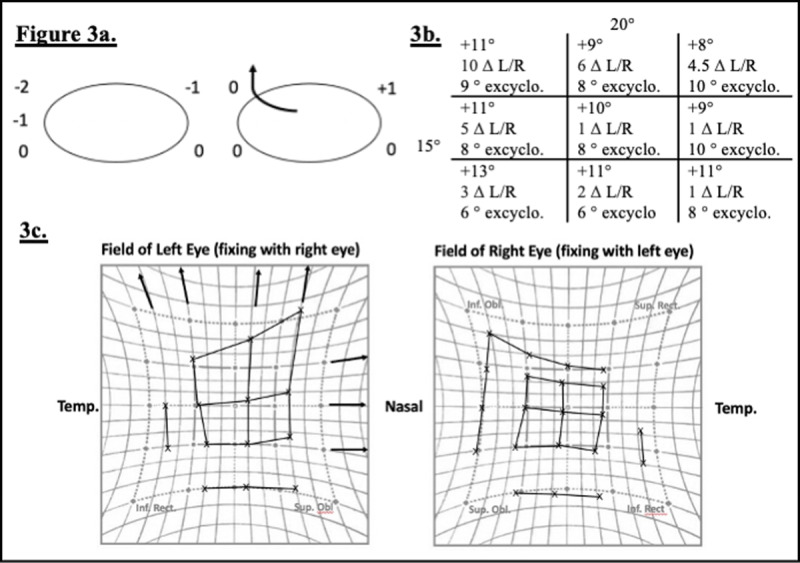 A Rare Case of Cyclotorsion Due to Medial Rectus Displacement Following Orbital Trauma.