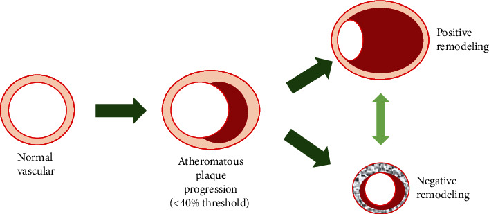 The Role of Angiotensin Antagonism in Coronary Plaque Regression: Insights from the Glagovian Model.