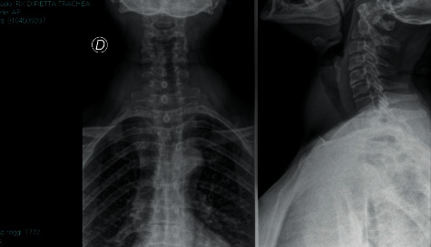 Use of Video Laryngoscope in Sedated Spontaneously Breathing Patients with Predicted Difficult Tracheal Intubation and Impossibility of Using Fibreoptic Bronchoscopy.