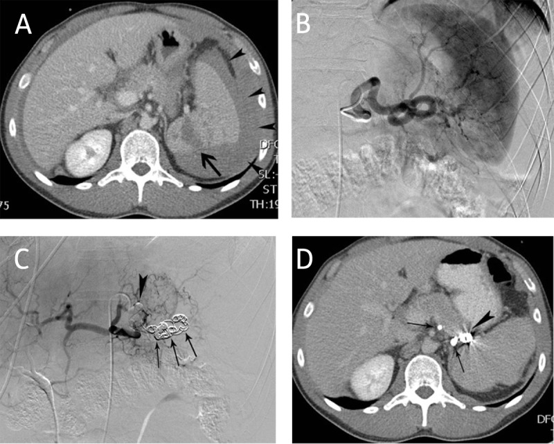 Residual Splenic Volume after Main Splenic Artery Embolization is Independent of the Underlying Disease.