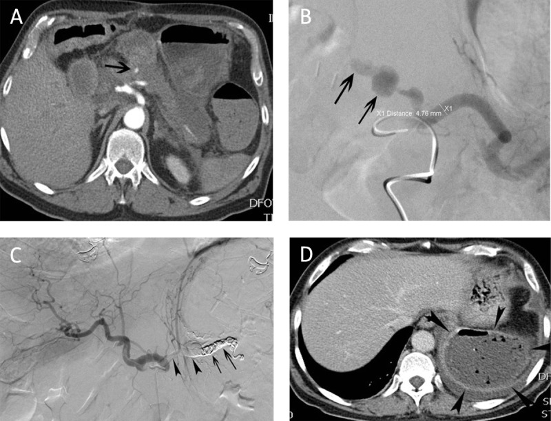 Residual Splenic Volume after Main Splenic Artery Embolization is Independent of the Underlying Disease.