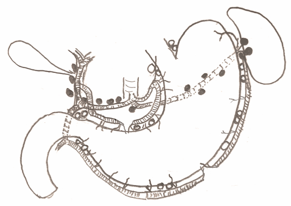 Retrospective Evaluation of Factors Affecting Lymph Node Retrieval Following Gastrectomies with Oncologic Intent.