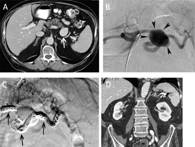 Residual Splenic Volume after Main Splenic Artery Embolization is Independent of the Underlying Disease.