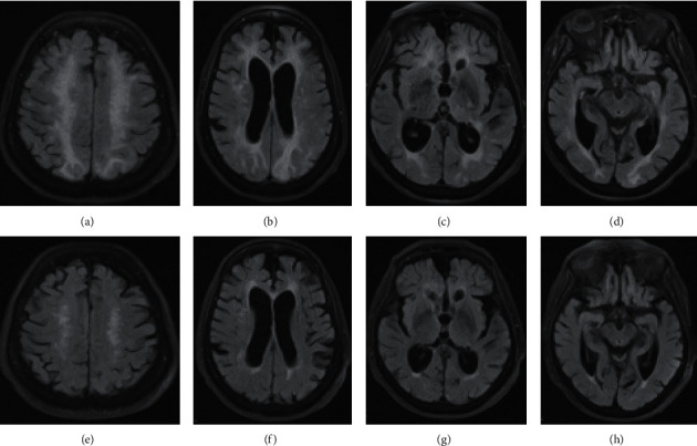 Posterior Reversible Leukoencephalopathy Syndrome in a Patient after Acute COVID-19 Infection.