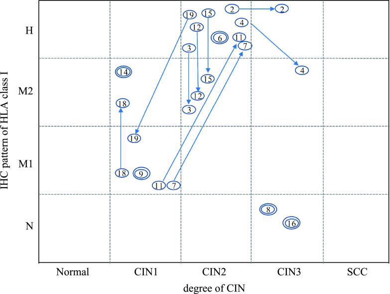 Altered Immunohistochemical Expression Patterns of HLA Class I during the Clinical Course of Cervical Intraepithelial Neoplasia.