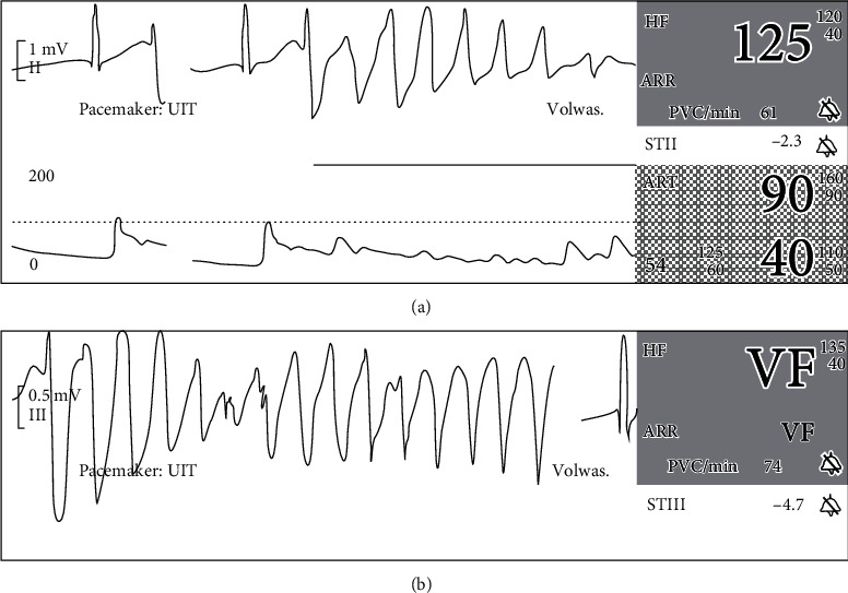 Nearly Fatal Hydroxychloroquine Overdose Successfully Treated with Midazolam, Propofol, Sodium Bicarbonate, Norepinephrine, and Intravenous Lipid Emulsion.