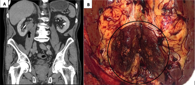 Papillary Renal Cell Carcinoma in Lynch/Muir-Torre Syndrome with Germline Pathogenic Variant in <i>MSH6</i> and Molecular Analysis: Report of a Case and Review of the Literature.