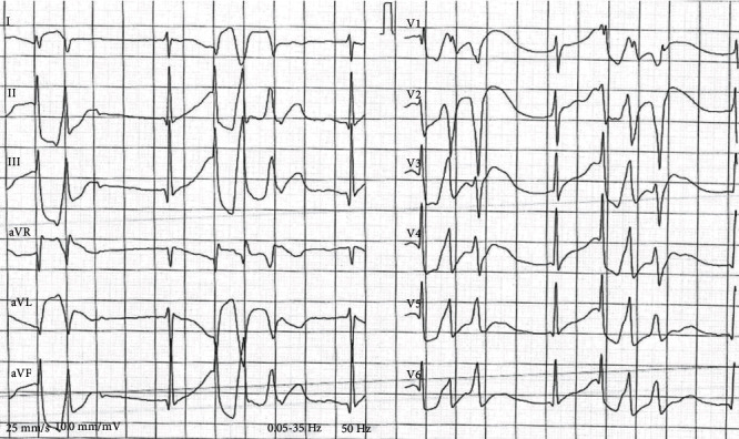 Nearly Fatal Hydroxychloroquine Overdose Successfully Treated with Midazolam, Propofol, Sodium Bicarbonate, Norepinephrine, and Intravenous Lipid Emulsion.