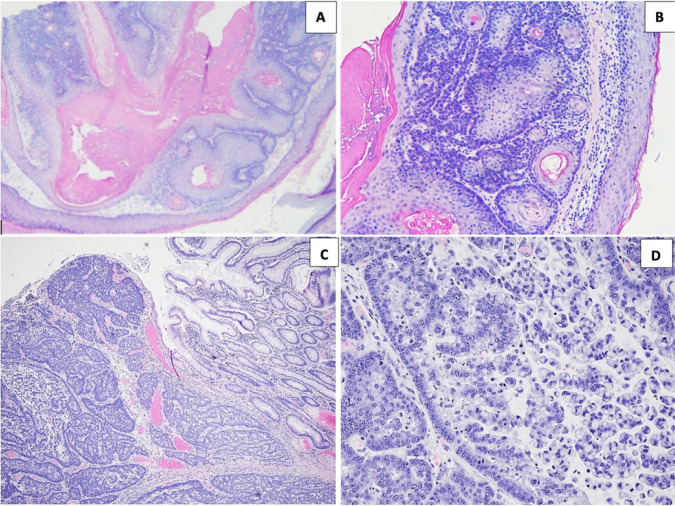 Papillary Renal Cell Carcinoma in Lynch/Muir-Torre Syndrome with Germline Pathogenic Variant in <i>MSH6</i> and Molecular Analysis: Report of a Case and Review of the Literature.