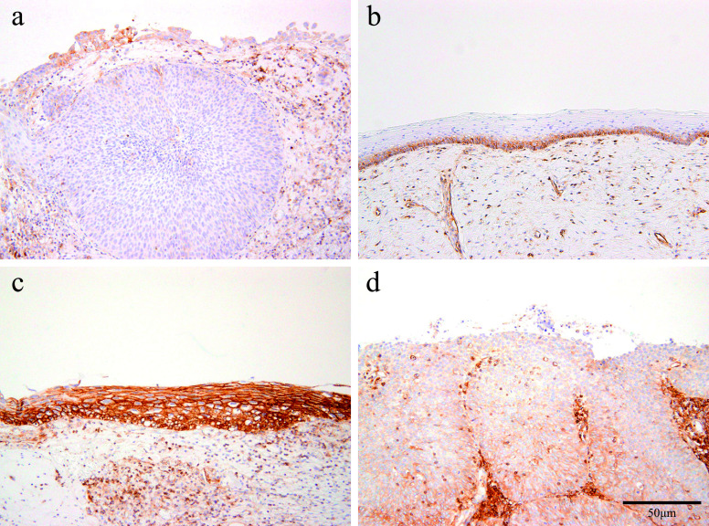 Altered Immunohistochemical Expression Patterns of HLA Class I during the Clinical Course of Cervical Intraepithelial Neoplasia.