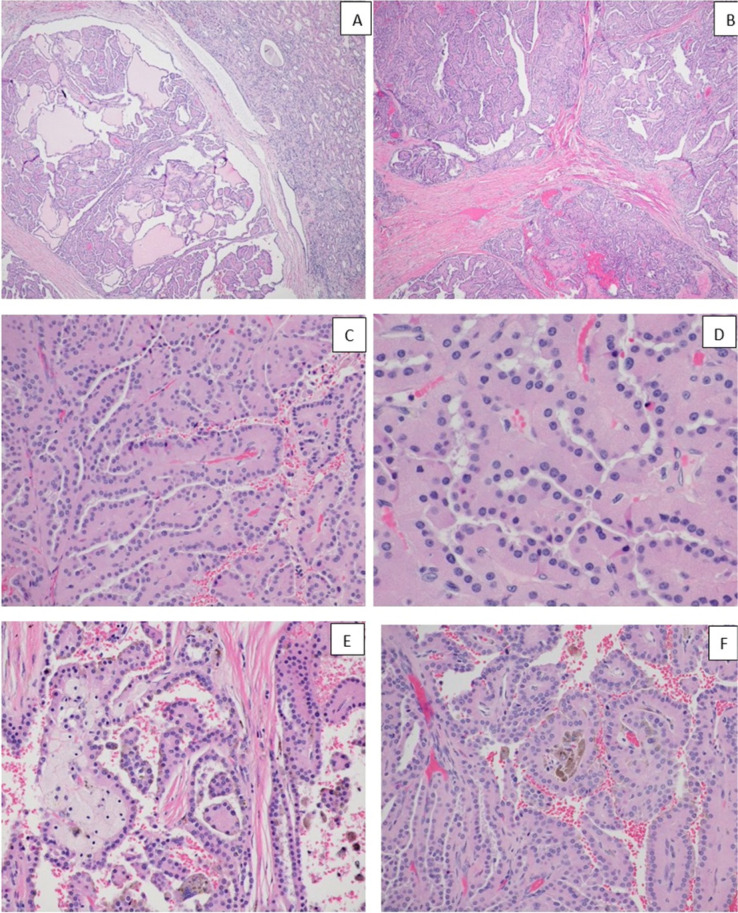 Papillary Renal Cell Carcinoma in Lynch/Muir-Torre Syndrome with Germline Pathogenic Variant in <i>MSH6</i> and Molecular Analysis: Report of a Case and Review of the Literature.