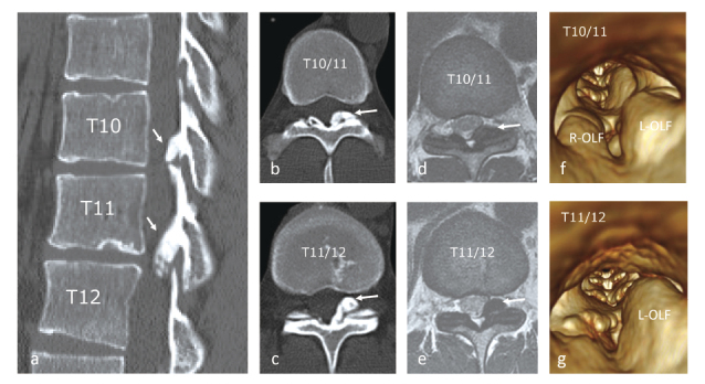 Ossification of the ligamentum flavum in the thoracic spine mimicking sciatica in a young baseball pitcher:a case report.