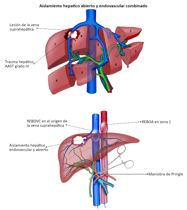 Hemodynamically unstable non-compressible penetrating torso trauma: a practical surgical approach.