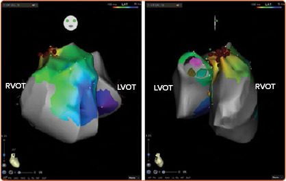 Electrocardiographic Criteria for Differentiating Left from Right Idiopathic Outflow Tract Ventricular Arrhythmias.