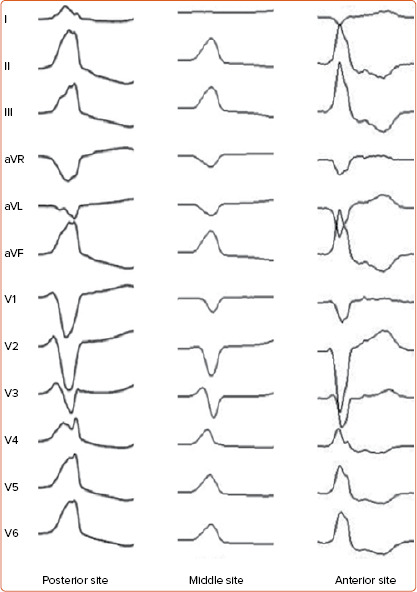 Electrocardiographic Criteria for Differentiating Left from Right Idiopathic Outflow Tract Ventricular Arrhythmias.