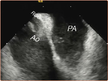 Electrocardiographic Criteria for Differentiating Left from Right Idiopathic Outflow Tract Ventricular Arrhythmias.