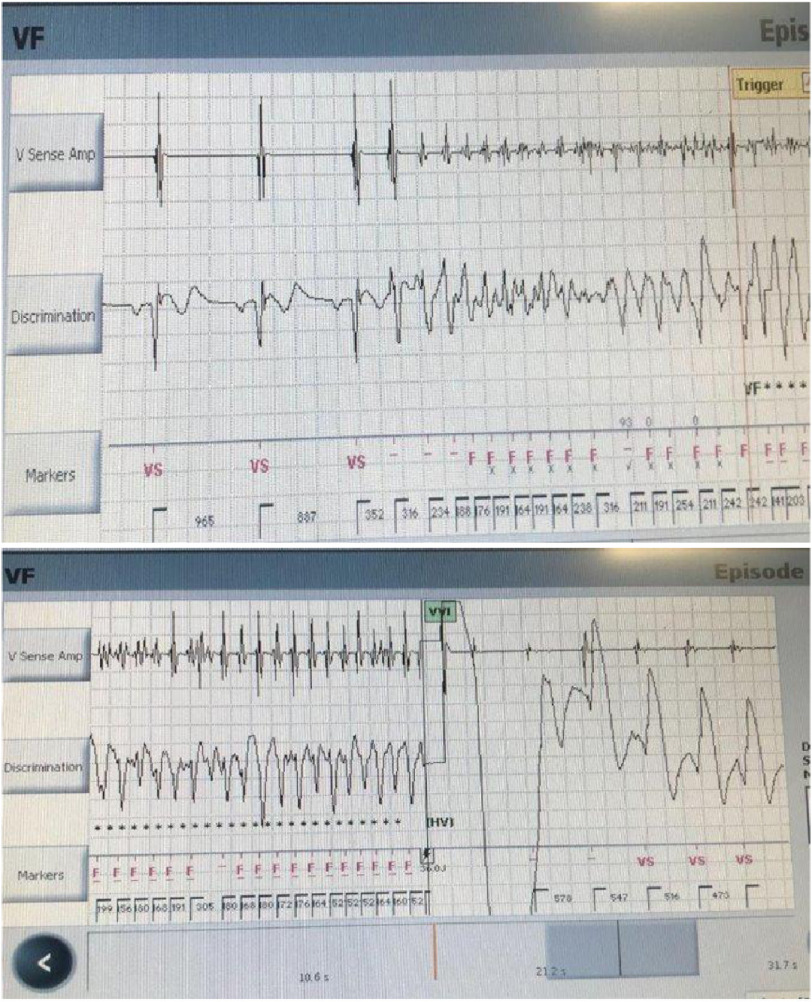 Ablation of a life-threatening arrhythmia in a patient with Brugada syndrome.