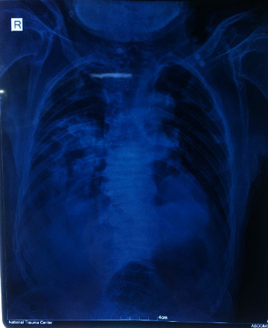 Continuous Spinal Anaesthesia for Intertrochanteric Femur Fracture in a Patient with Skeletal Dysplasia.