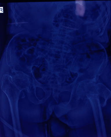 Continuous Spinal Anaesthesia for Intertrochanteric Femur Fracture in a Patient with Skeletal Dysplasia.