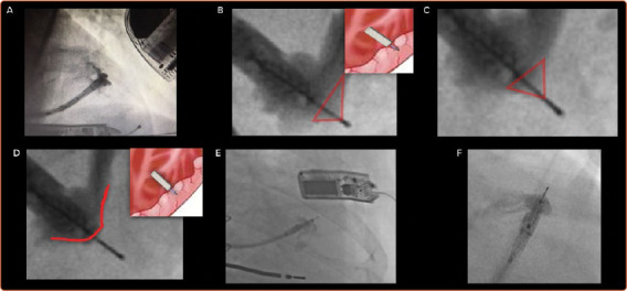 Leadless Left Ventricular Endocardial Pacing and Left Bundle Branch Area Pacing for Cardiac Resynchronisation Therapy.