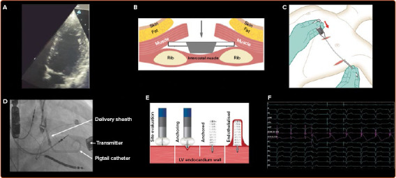 Leadless Left Ventricular Endocardial Pacing and Left Bundle Branch Area Pacing for Cardiac Resynchronisation Therapy.