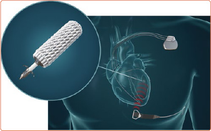 Leadless Left Ventricular Endocardial Pacing and Left Bundle Branch Area Pacing for Cardiac Resynchronisation Therapy.