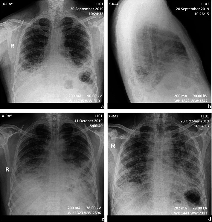 Atypical respiratory distress in eastern Democratic Republic of the Congo prior to the COVID-19 pandemic. A case report.