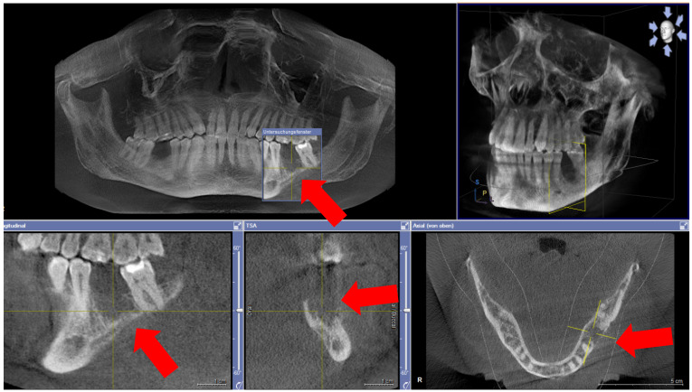 Eggerthia catenaformis infection originating from a dental abscess causes severe intestinal complications and osteomyelitis of the jaw.