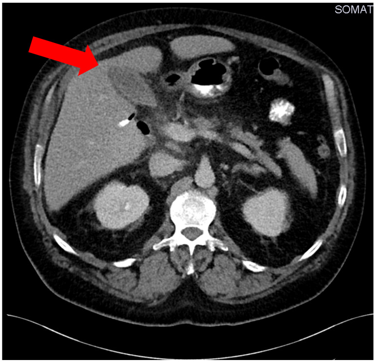 Eggerthia catenaformis infection originating from a dental abscess causes severe intestinal complications and osteomyelitis of the jaw.