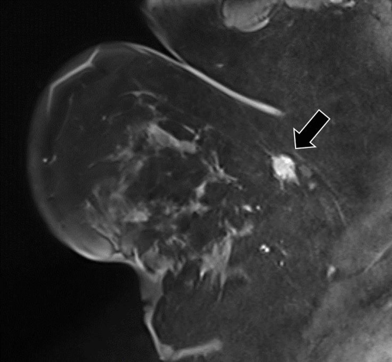 Granular Cell Tumor: A Mimicker of Breast Carcinoma.