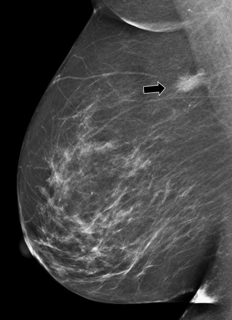 Granular Cell Tumor: A Mimicker of Breast Carcinoma.