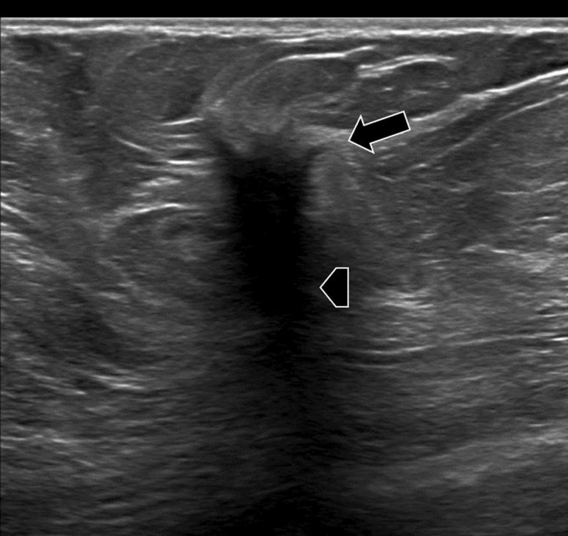 Granular Cell Tumor: A Mimicker of Breast Carcinoma.