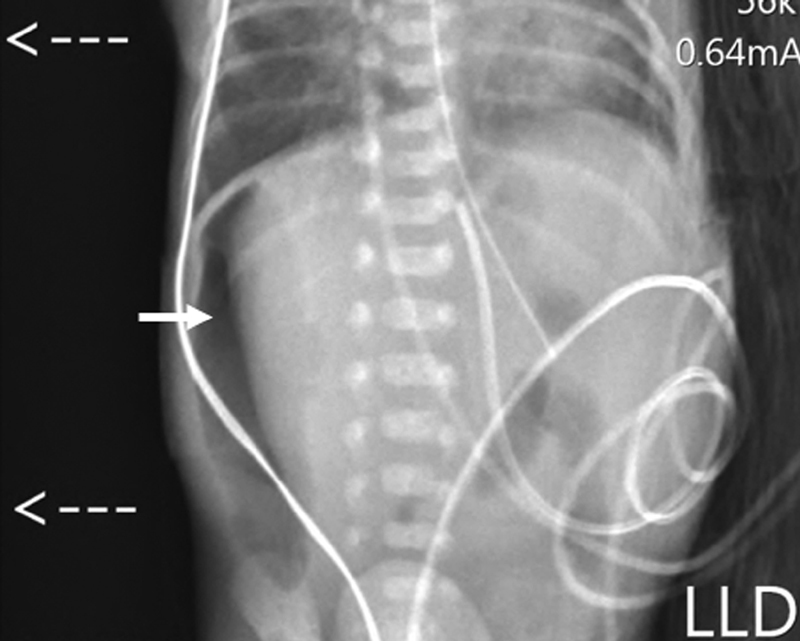 A Case of an Extremely Low Birth Weight Infant with <i>Morganella morganii</i> Bacteremia and Peritonitis.