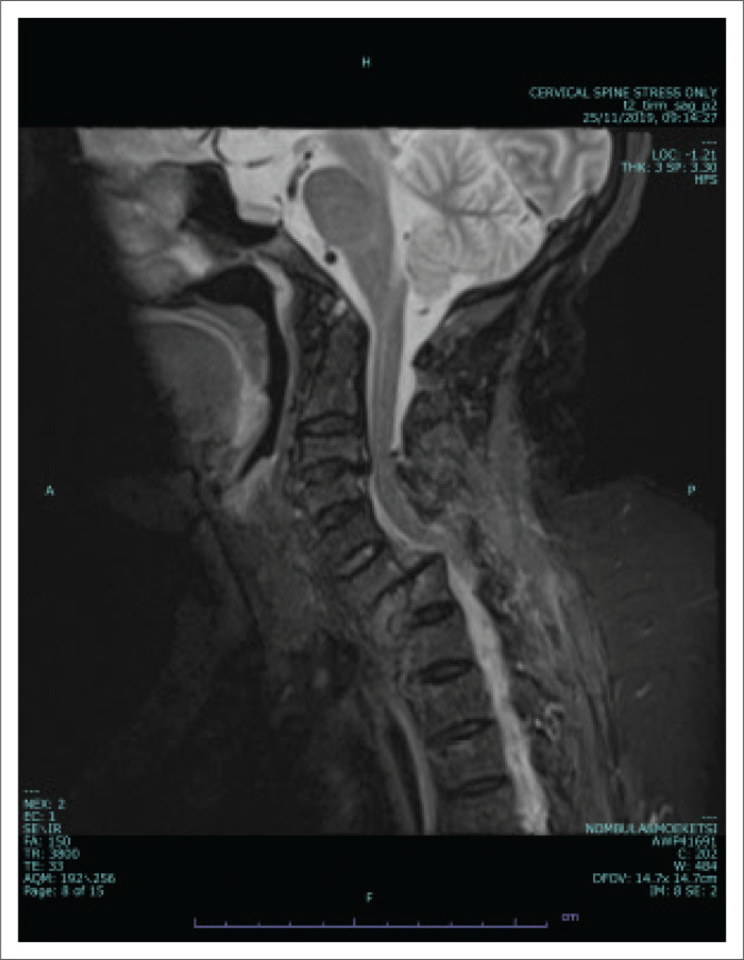 Correlation of blunt cervical spinal cord injury magnetic resonance imaging tractography with the American Spinal Injury Association impairment scale motor scores.