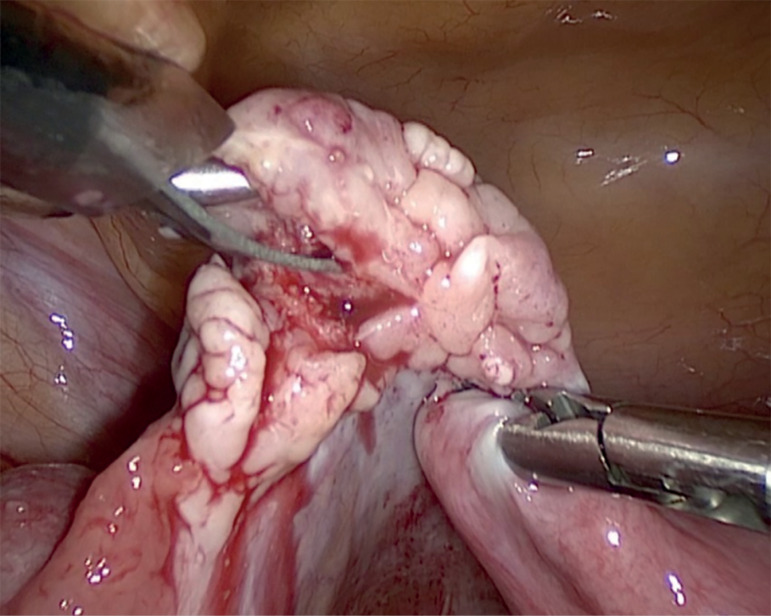 Long-term outcome of ovarian function after drug-free in vitro activation (IVA) in primary ovarian insufficiency patient.