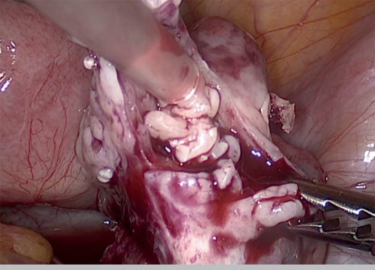 Long-term outcome of ovarian function after drug-free in vitro activation (IVA) in primary ovarian insufficiency patient.