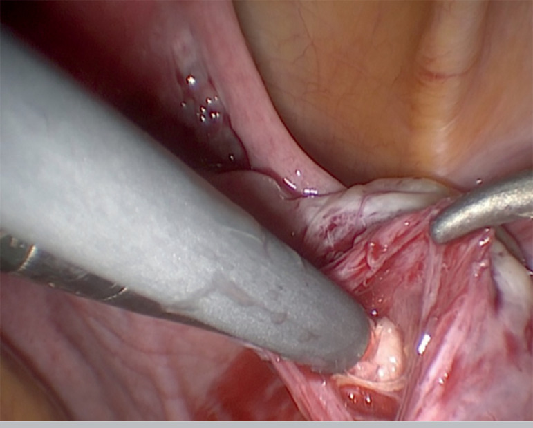 Long-term outcome of ovarian function after drug-free in vitro activation (IVA) in primary ovarian insufficiency patient.