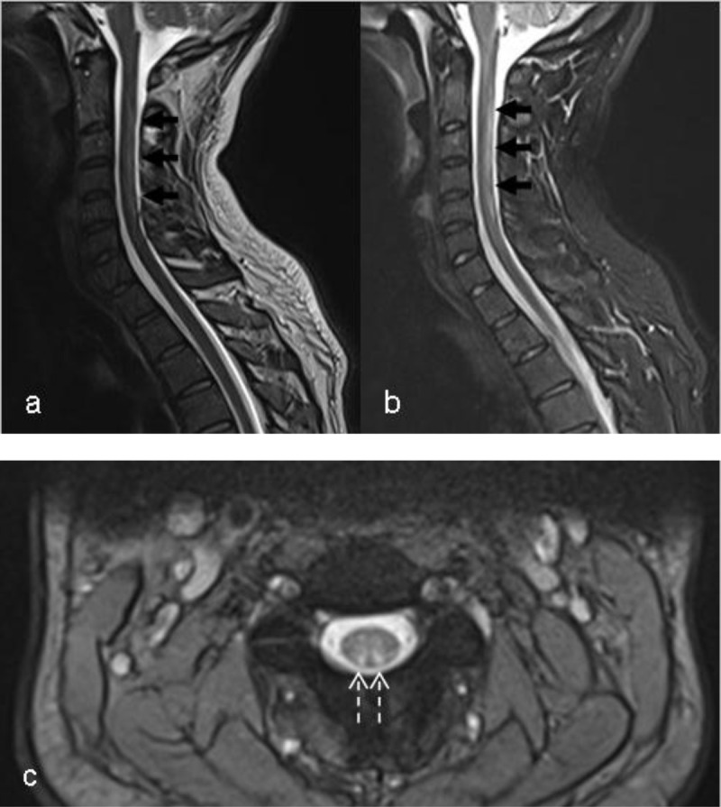 MRI of Nitrous Oxide-Related Subacute Cervical Myelopathy.