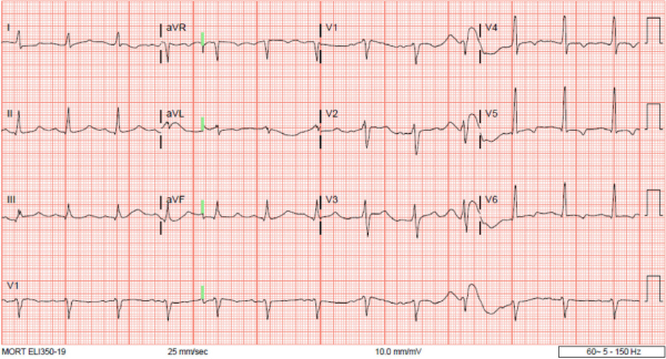 Alternating and Concurrent True Hyperkalemia and Pseudohyperkalemia in Adult Sickle Cell Disease.