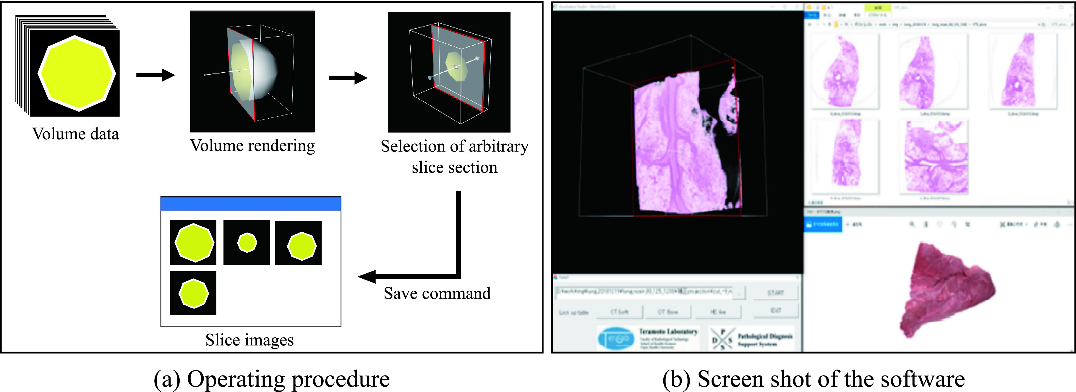 Development of Pathological Diagnosis Support System Using Micro-computed Tomography.