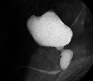 Rare Associations with Posterior Urethral Valves.