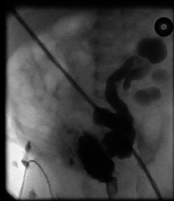 Rare Associations with Posterior Urethral Valves.