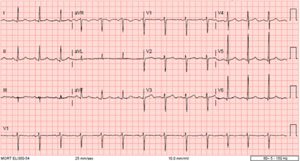 Alternating and Concurrent True Hyperkalemia and Pseudohyperkalemia in Adult Sickle Cell Disease.