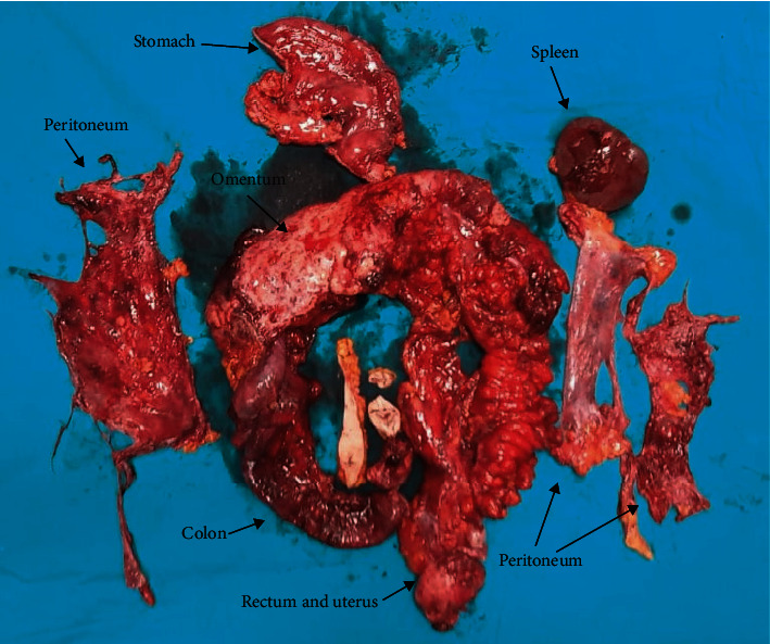 Cytoreductive Surgery and Perioperative Intraperitoneal Chemotherapy Experience in Peritoneal Carcinomatosis: Single-Center Analysis of 180 Cases.