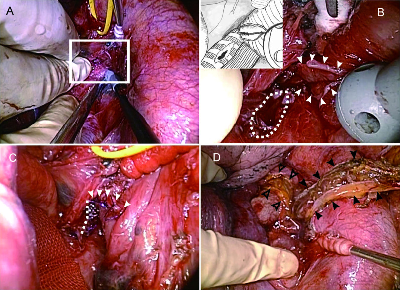 Successful Surgical Closure of an Esophagobronchial Fistula Caused by a Foreign Body in the Esophagus of a Female Octogenarian with a Delayed Diagnosis: A Case Report.