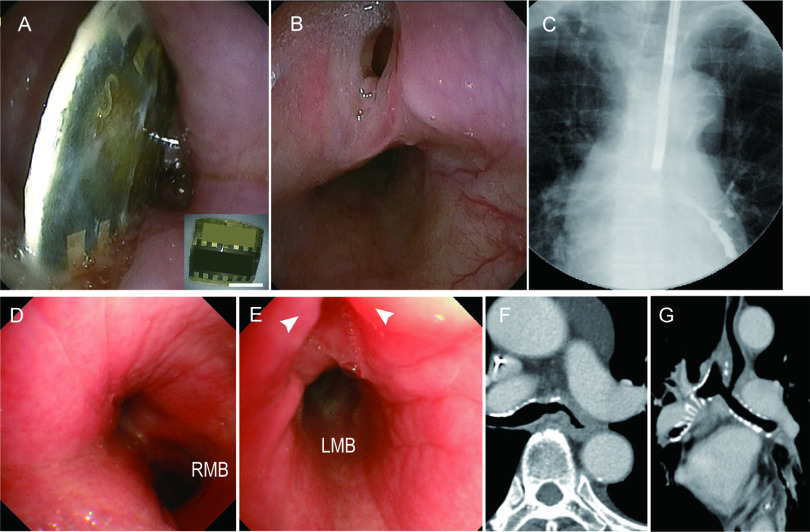 Successful Surgical Closure of an Esophagobronchial Fistula Caused by a Foreign Body in the Esophagus of a Female Octogenarian with a Delayed Diagnosis: A Case Report.